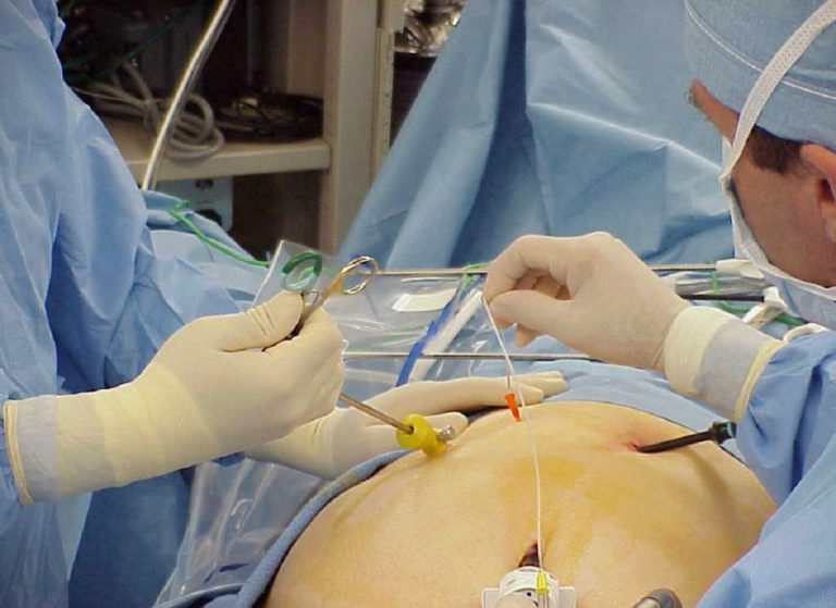 Cómo se realiza una laparoscopia