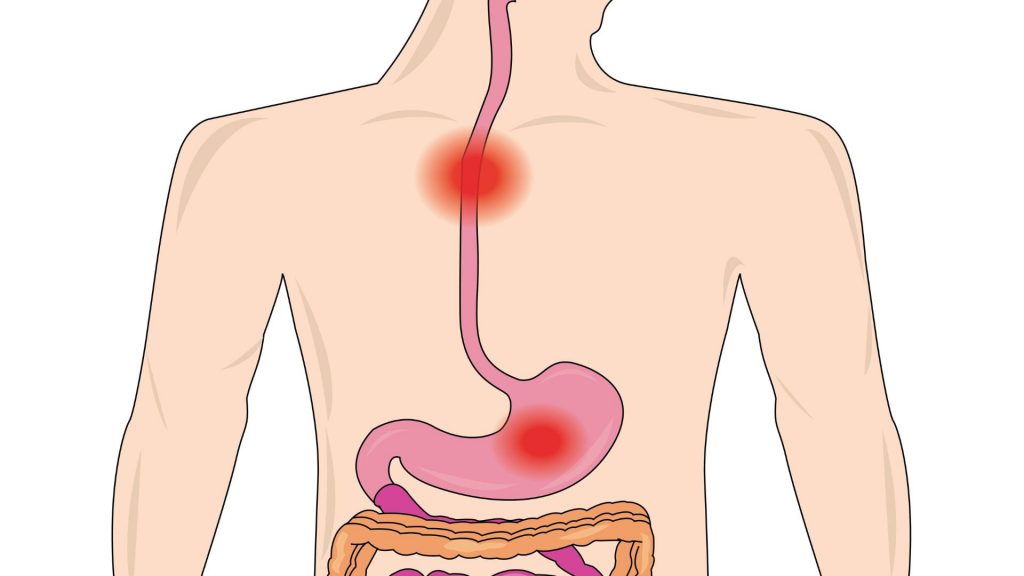 Especialista en esofagitis en San Luis Potosí