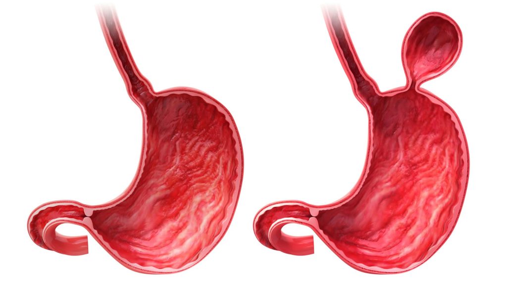 Especialista en hernia hiatal en San Luis Potosí