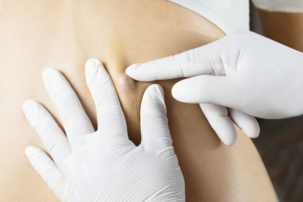 Especialista en quiste epidermoide en San Luis Potosí