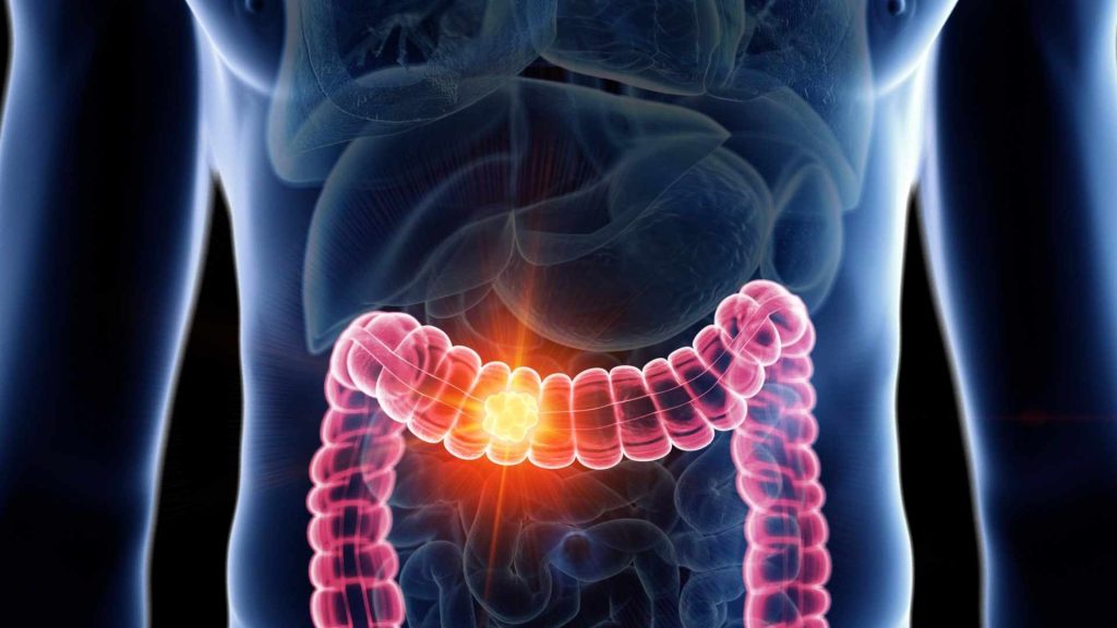 Especialista en colon irritable en San Luis Potosí