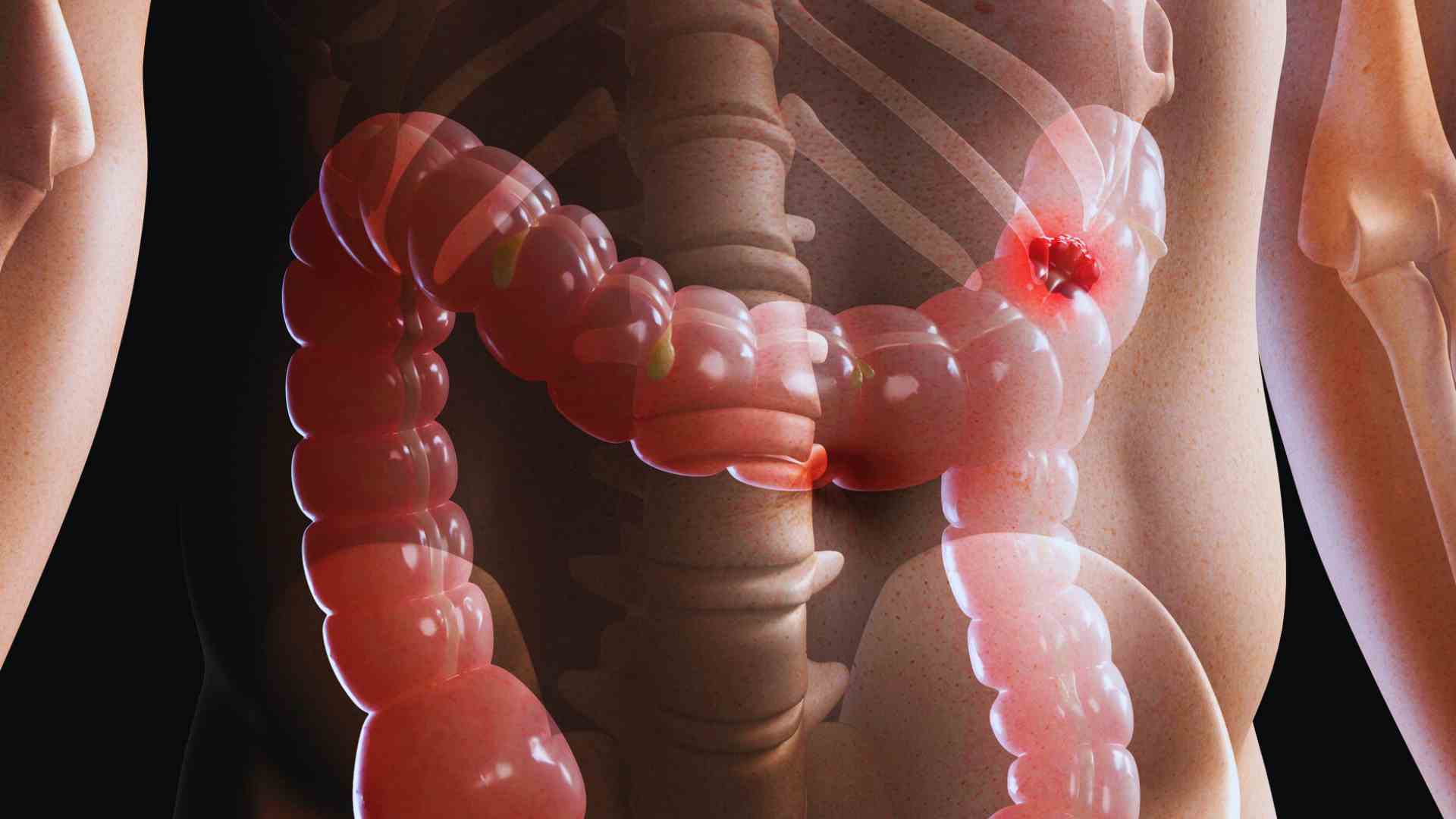Especialista en hernia hiatal en San Luis Potosí Especialista en oclusión intestinal en San Luis Potosí