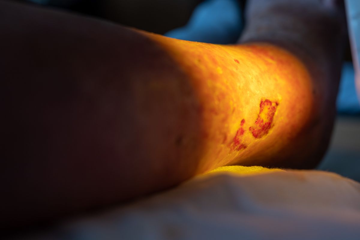 Especialista en úlceras cutáneas en San Luis Potosí